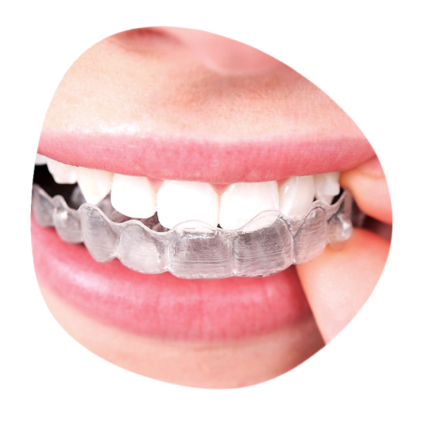 Invisible-orthodontic-treatment-with-Invisalign-le-chantier-dental-clinic2